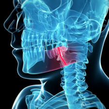 medical illustration of a broken jaw bone