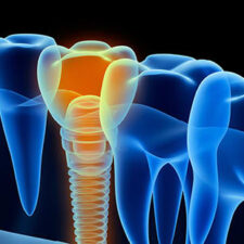 dental-implants-carejpg